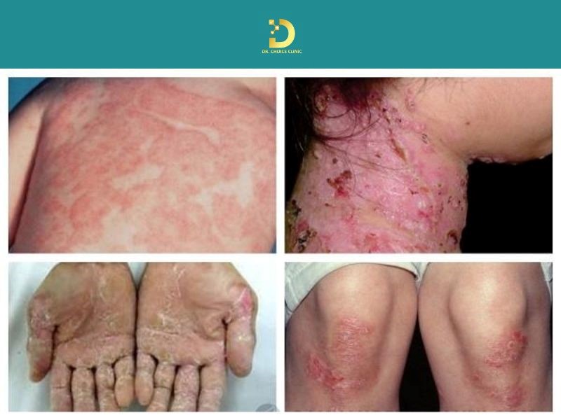 Pellagra: Dấu Hiệu, Nguyên Nhân, Biến Chứng Và Cách Điều Trị, Phòng Ngừa 9 Biểu hiện ngoài da đặc trưng của bệnh Pellagra