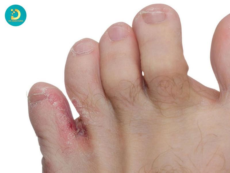 Nấm Kẽ Chân: Nguyên Nhân, Triệu Chứng Và Cách Điều Trị Dứt Điểm 10 Hình ảnh bệnh nấm kẽ chân
