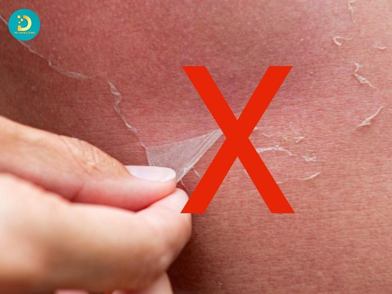 Sạm Da, Cháy Nắng Phải Làm Sao? Top Cách Khắc Phục Hiệu Quả 20 Không tự bóc lớp da đang bong tróc: