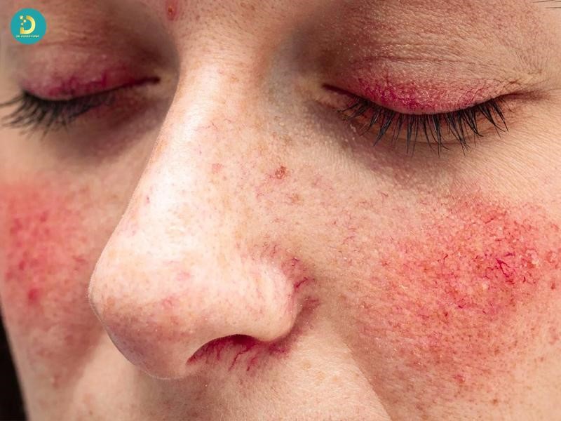 Hình ảnh bị Lupus ban đỏ hệ thống