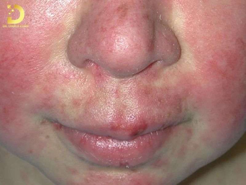 Lupus ban đỏ