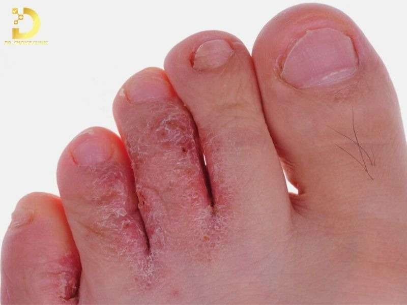 Nấm da các thể: kẽ chân, móng, tóc