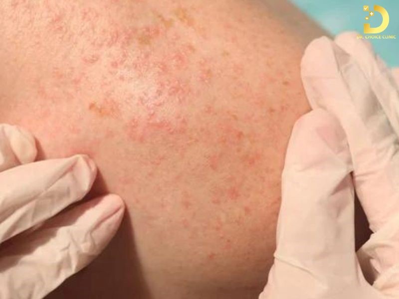 Rôm Sảy: Nguyên Nhân, Triệu Chứng, Cách Điều Trị Và Phòng Ngừa 8 Rôm sảy bắt nguồn từ tình trạng tắc nghẽn tuyến mồ hôi