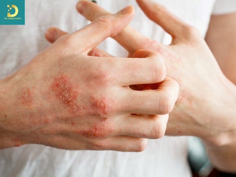 Pellagra: Dấu Hiệu, Nguyên Nhân, Biến Chứng Và Cách Điều Trị, Phòng Ngừa 10 Pellagra phát triển khi cơ thể không được cung cấp đủ niacin