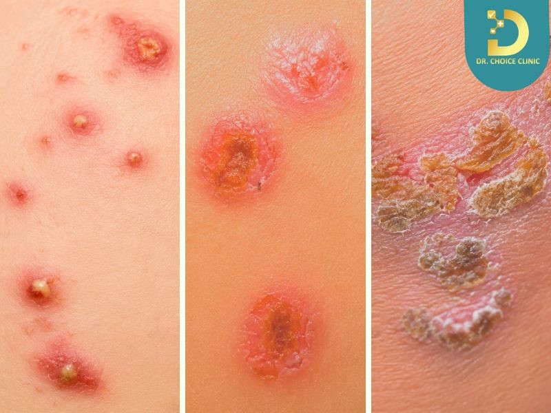 Các loại viêm da mủ trẻ em phổ biến