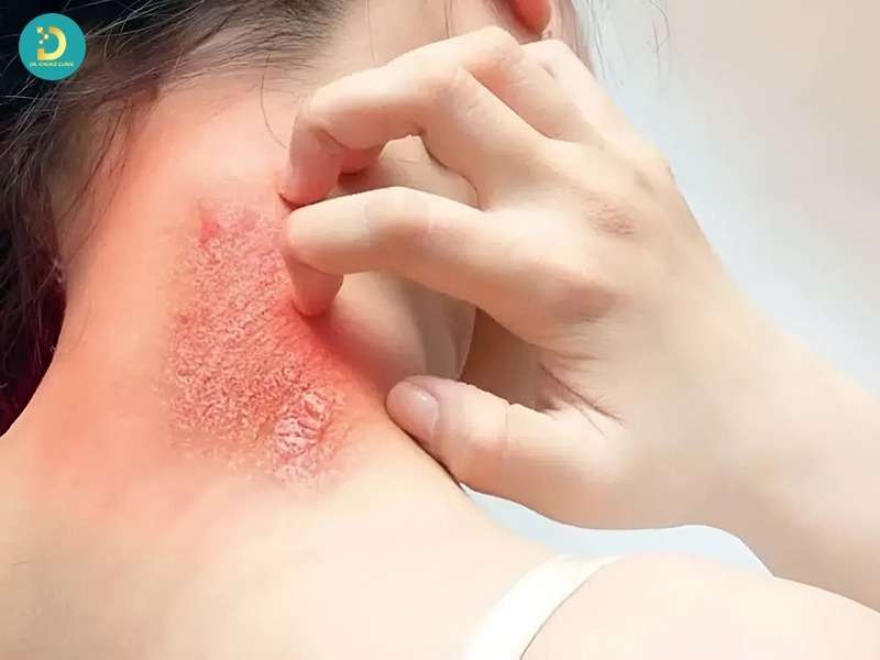 Những yếu tố làm tăng nguy cơ nhiễm trùng da