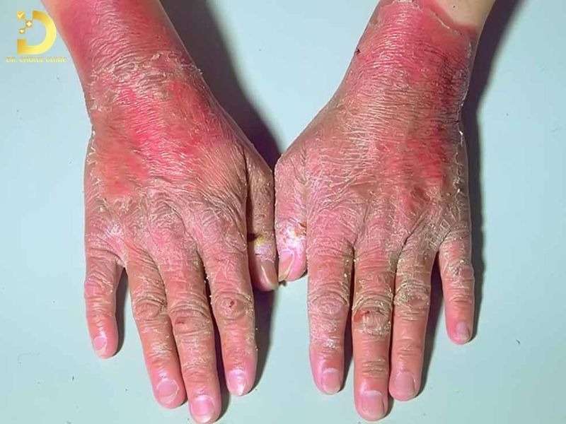 Pellagra