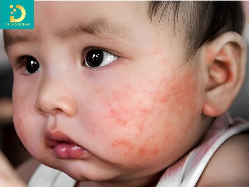 Viêm da tiếp xúc ở trẻ em có biểu hiện dễ nhầm lẫn với nhiều bệnh da liễu khác