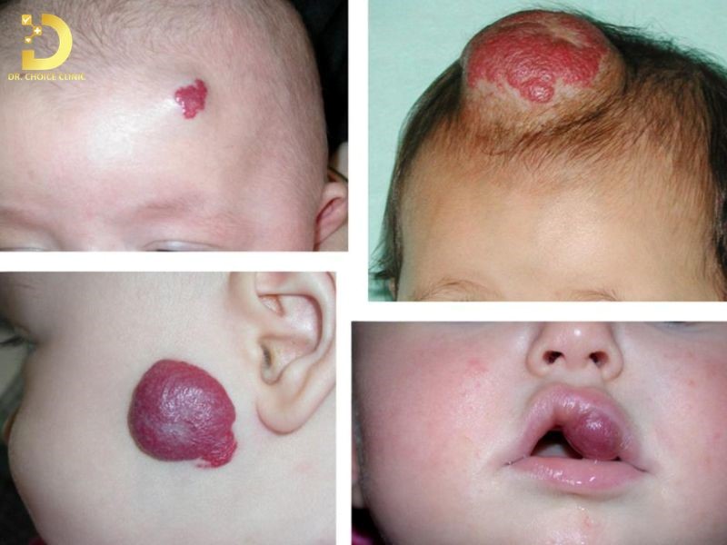 U máu được phân loại dựa trên độ sâu, phân bố và vị trí