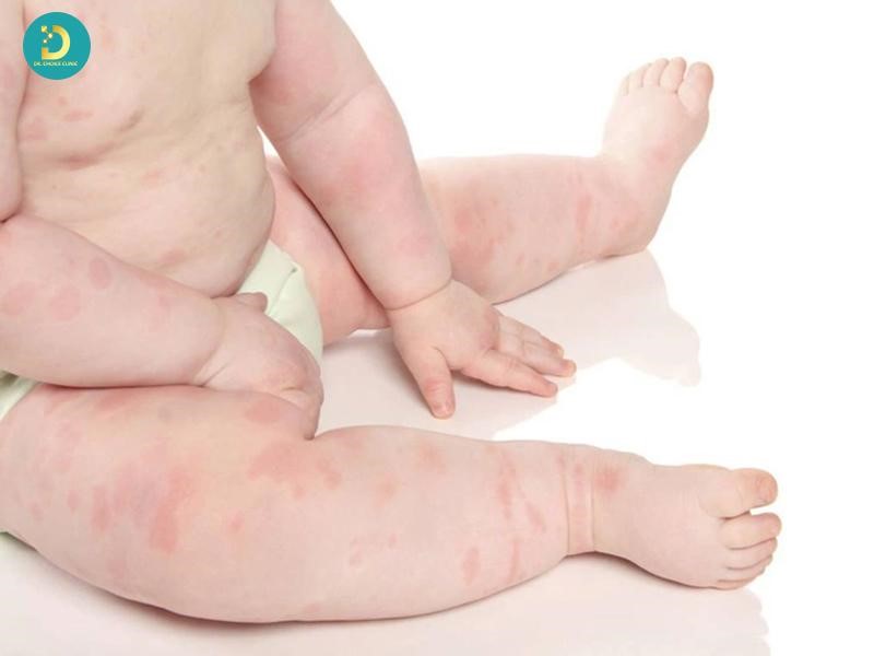 Các Loại Phát Ban Ở Trẻ: Cách Phân Biệt & Xử Lý Hiệu Quả 15 Phát ban dị ứng ở trẻ em