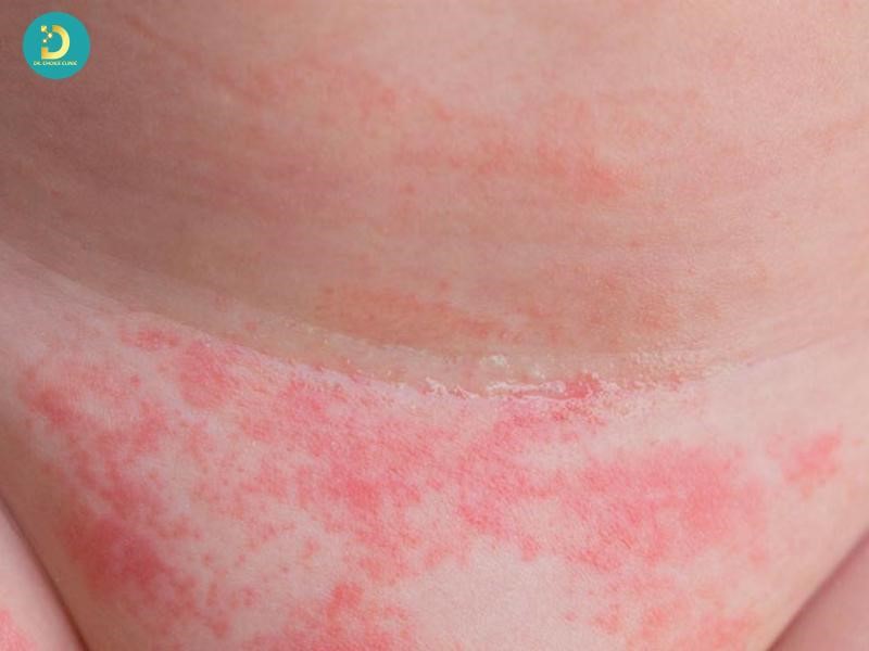 Các Loại Phát Ban Ở Trẻ: Cách Phân Biệt & Xử Lý Hiệu Quả 17 Phát ban do viêm da cơ địa ở trẻ em