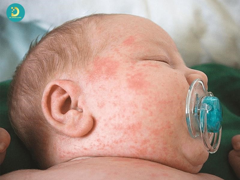 Các Loại Phát Ban Ở Trẻ: Cách Phân Biệt & Xử Lý Hiệu Quả 14 Sốt phát ban do virus