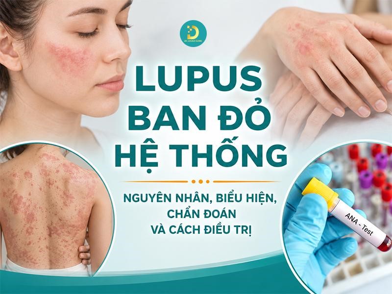 Tìm hiểu bệnh Lupus ban đỏ hệ thống