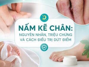 Tìm hiểu bệnh nấm kẽ chân