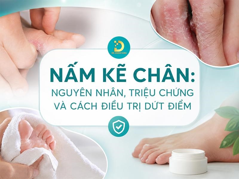 Nấm Kẽ Chân: Nguyên Nhân, Triệu Chứng Và Cách Điều Trị Dứt Điểm 9 Tìm hiểu bệnh nấm kẽ chân