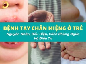 Tìm hiểu bệnh tay chân miệng ở trẻ em