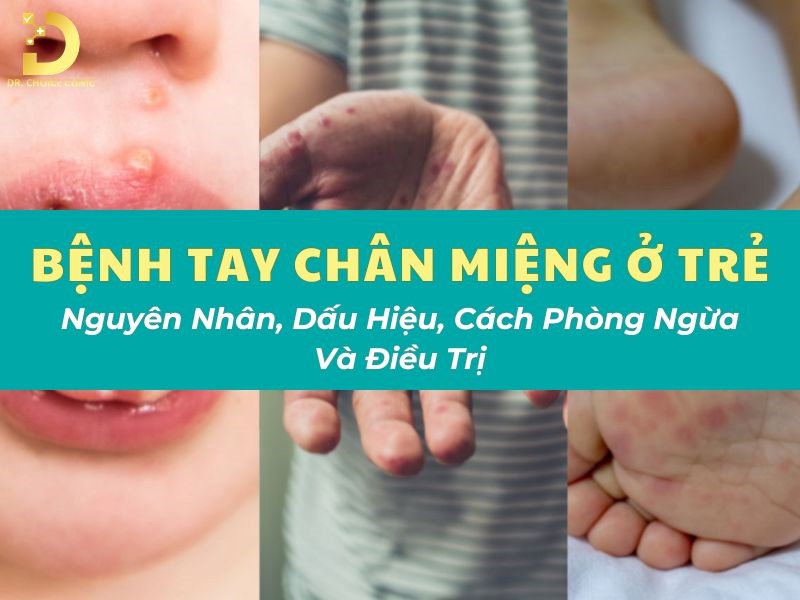 Bệnh Tay Chân Miệng Ở Trẻ: Nguyên Nhân, Dấu Hiệu, Cách Phòng Ngừa Và Điều Trị 9 Tìm hiểu bệnh tay chân miệng ở trẻ em
