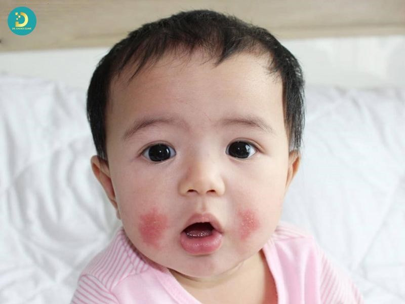 Viêm da cơ địa trẻ em (hay còn gọi là chàm thể tạng, chàm sữa, eczema) là bệnh da liễu mạn tính rất phổ biến