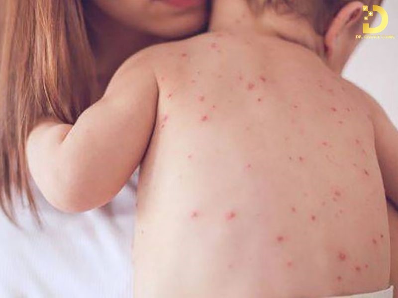 Rôm Sảy: Nguyên Nhân, Triệu Chứng, Cách Điều Trị Và Phòng Ngừa 9 Bệnh thường xuất hiện ở vùng da ra nhiều mồ hôi, kèm theo cảm giác ngứa và châm chích