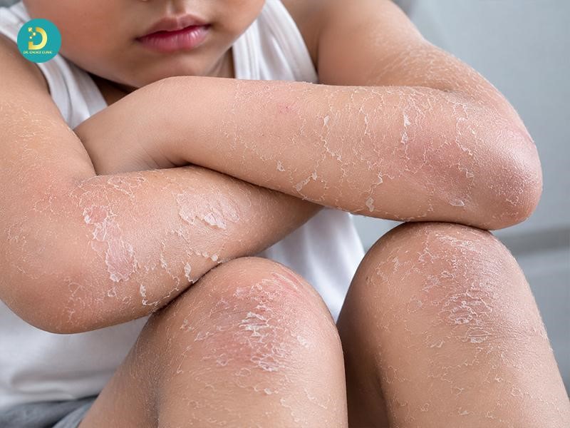 Vị trí thường xuất hiện bệnh vảy cá trẻ em