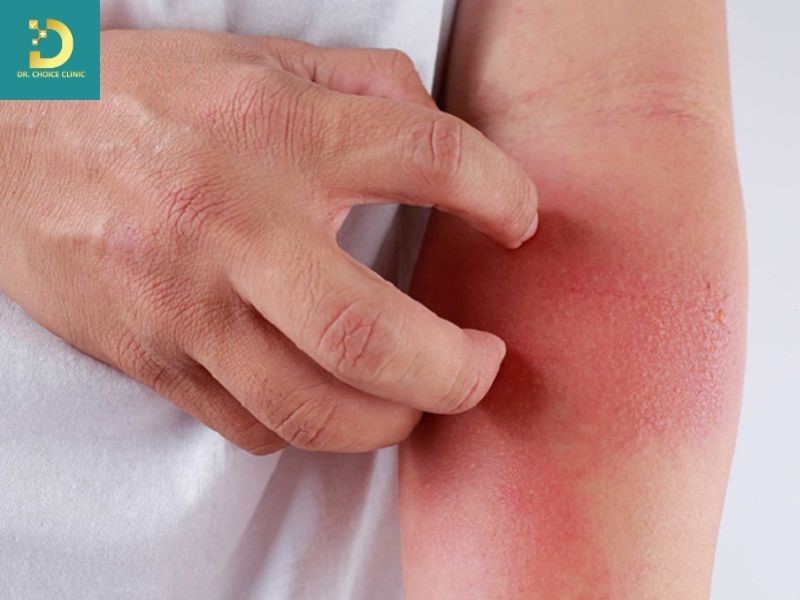 Viêm Da Tiếp Xúc Ánh Sáng: Nguyên Nhân, Triệu Chứng, Chẩn Đoán Và Điều Trị 14 Người bệnh viêm da tiếp xúc ánh sáng thường có cảm giác châm chít hoặc ngứa