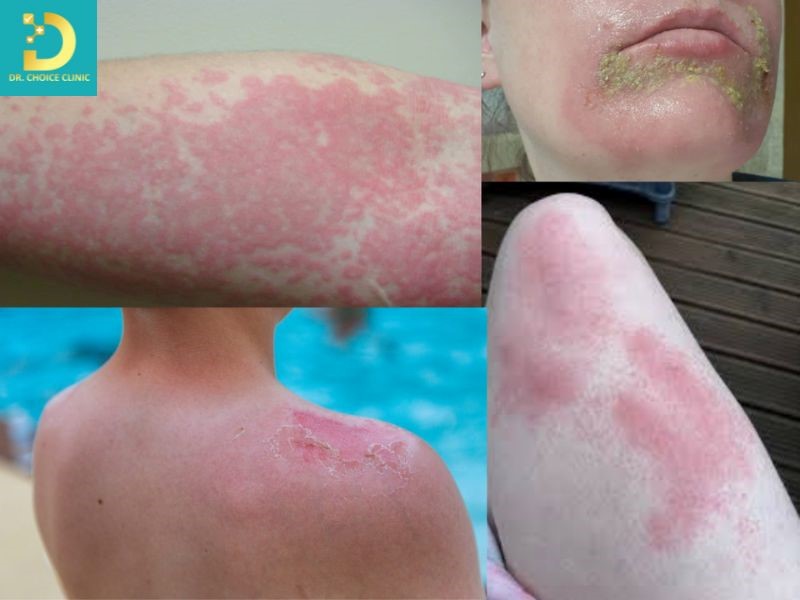 Porphyria Da: Nguyên Nhân, Triệu Chứng, Chẩn Đoán Và Điều Trị 10 Porphyria da thường biểu hiện bằng các tổn thương da như phỏng rộp, da mỏng dễ tổn thương và thay đổi sắc tố