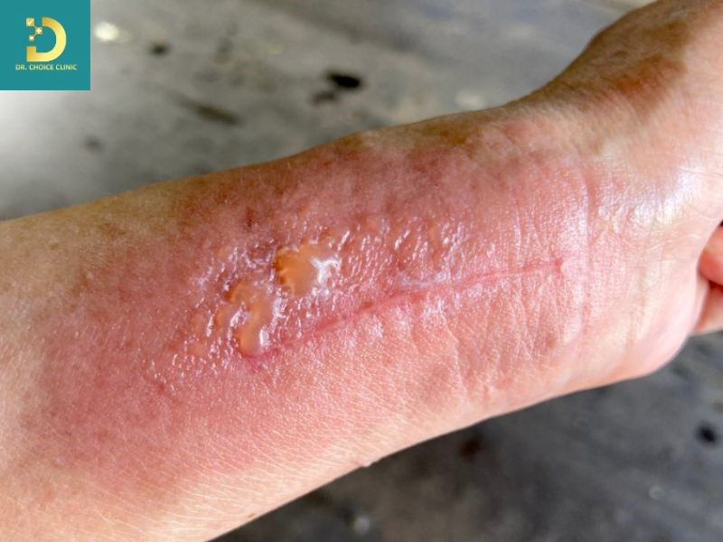 Viêm Da Tiếp Xúc Ánh Sáng: Nguyên Nhân, Triệu Chứng, Chẩn Đoán Và Điều Trị 12 Người bị viêm da tiếp xúc ánh sáng làn da thường đỏ rát, sưng và có thể phồng rộp giống như cháy nắng nặng