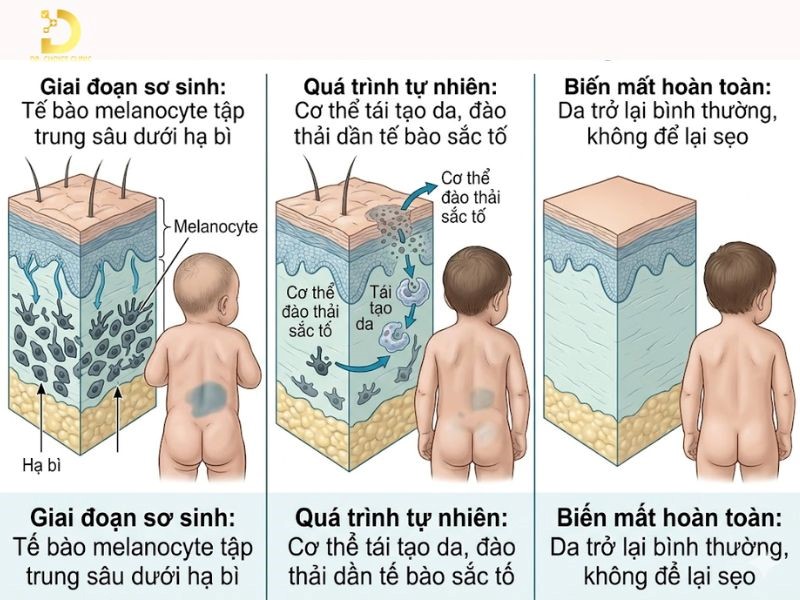 Vết bớt Mông Cổ thường tự mờ dần theo thời gian