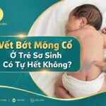 Tìm hiểu về vết bớt mông cổ ở trẻ sơ sinh