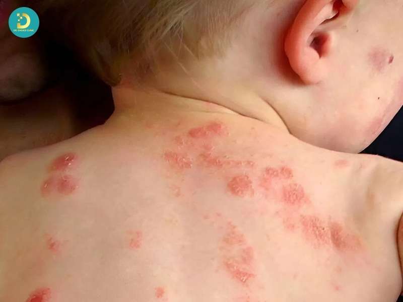 Vì sao trẻ nhỏ dễ bị chốc lở hơn người lớn?