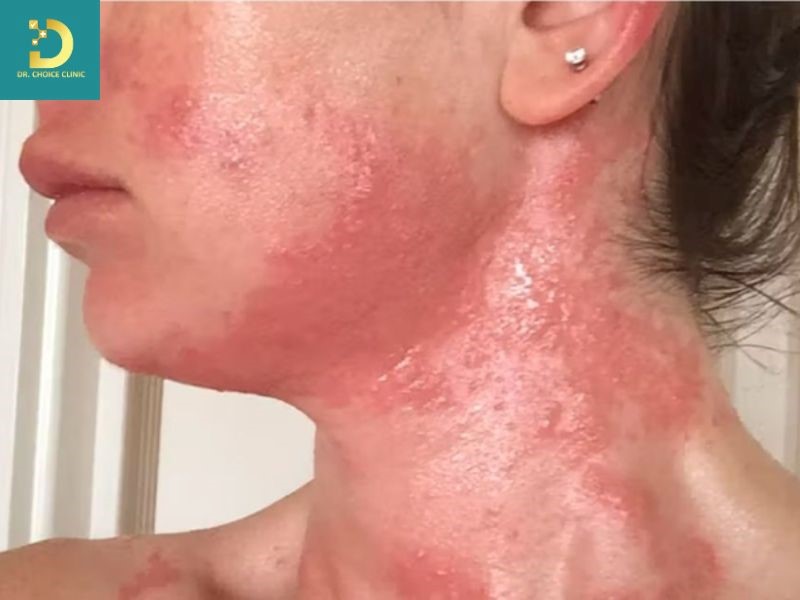 Viêm Da Tiếp Xúc Ánh Sáng: Nguyên Nhân, Triệu Chứng, Chẩn Đoán Và Điều Trị 13 Tổn thương thường tập trung ở các vùng da hở như mặt, cổ, gáy