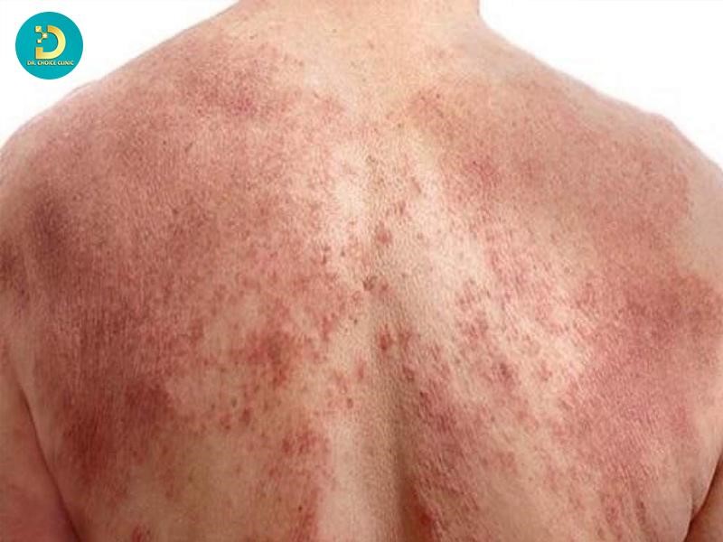 Hướng Dẫn Chăm Sóc Viêm Da Cơ Địa Vào Mùa Hè Hiệu Quả 18 Vùng da xuất hiện dấu hiệu nhiễm trùng nên thăm khám y tế