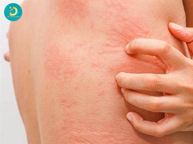 Hướng Dẫn Chăm Sóc Viêm Da Cơ Địa Vào Mùa Hè Hiệu Quả 19 Tổn thương da lan rộng hoặc kèm theo triệu chứng toàn thân nên thăm khám y tế
