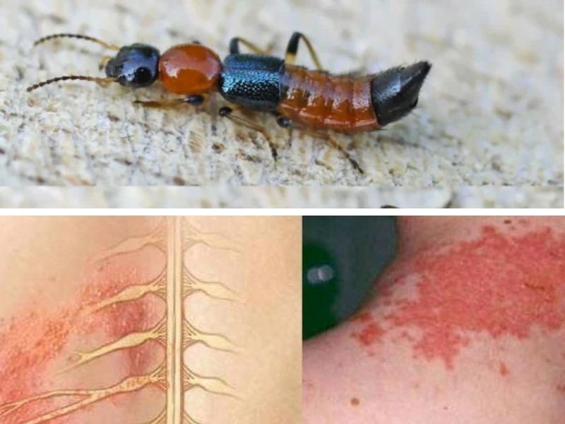 Viêm Da Tiếp Xúc Do Côn Trùng: Triệu Chứng Và Cách Xử Lý Hiệu Quả 9 Viêm da tiếp xúc do côn trùng xảy ra khi da tiếp xúc với độc tố từ côn trùng