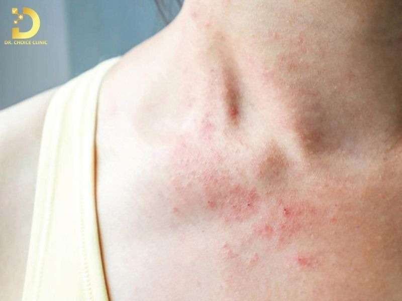 Viêm da tiết bã