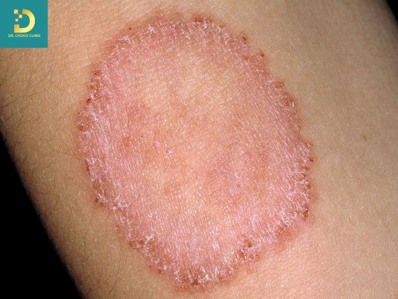 Các Bệnh Da Do Vi Nấm Thường Gặp Và Cách Điều Trị 13 Bệnh hắc lào (ảnh minh họa)