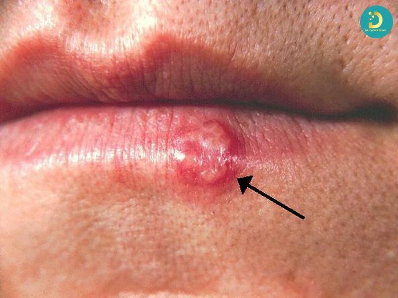 Herpes Là Gì? Nguyên Nhân, Dấu Hiệu & Cách Điều Trị, Phòng Ngừa 11 Bệnh Herpes (ảnh minh họa)