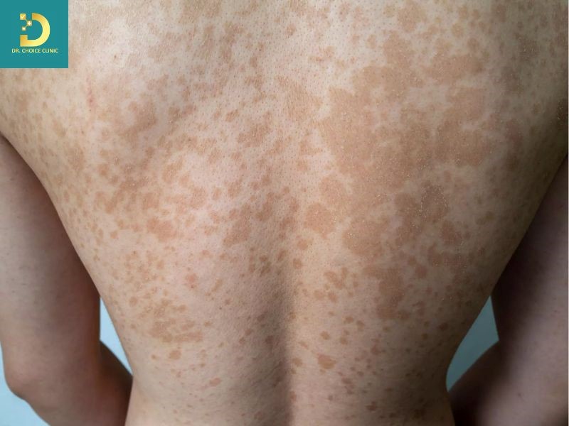 Các Bệnh Da Do Vi Nấm Thường Gặp Và Cách Điều Trị 12 Bệnh lang ben (ảnh minh họa)