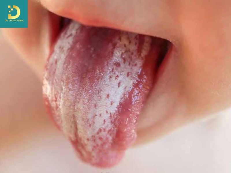 Các Bệnh Da Do Vi Nấm Thường Gặp Và Cách Điều Trị 17 Nấm da do nấm Candida (ảnh minh họa)