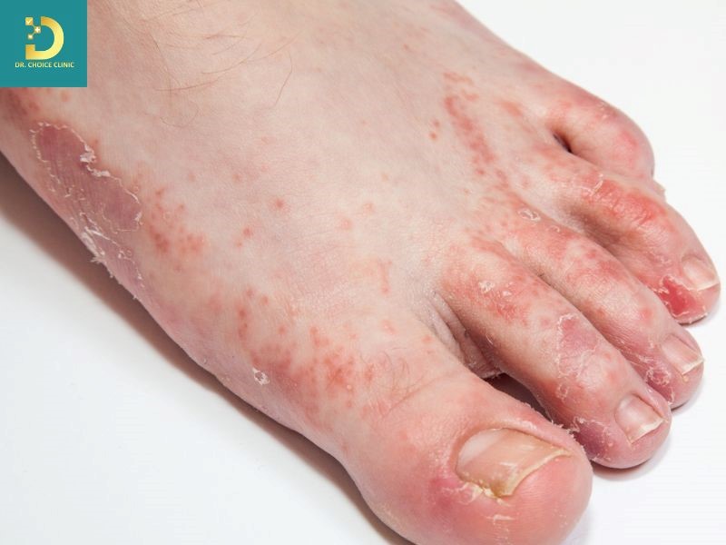 Các Bệnh Da Do Vi Nấm Thường Gặp Và Cách Điều Trị 14 Bệnh nấm kẽ chân (ảnh minh họa)