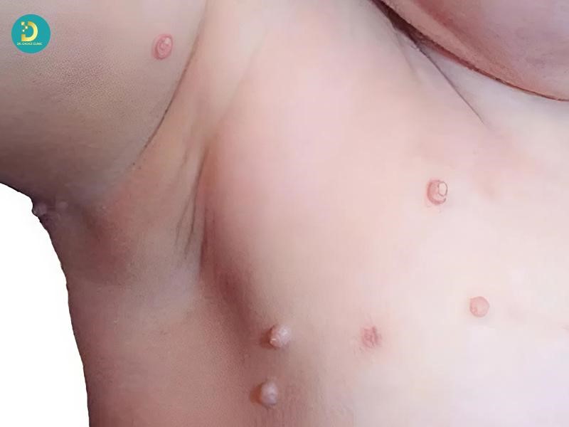 Bệnh u mềm lây ở trẻ em (ảnh minh họa)