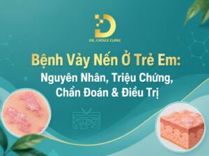 Tìm hiểu bệnh vảy nến ở trẻ em: nguyê nhân, triệu chứng và điều trị