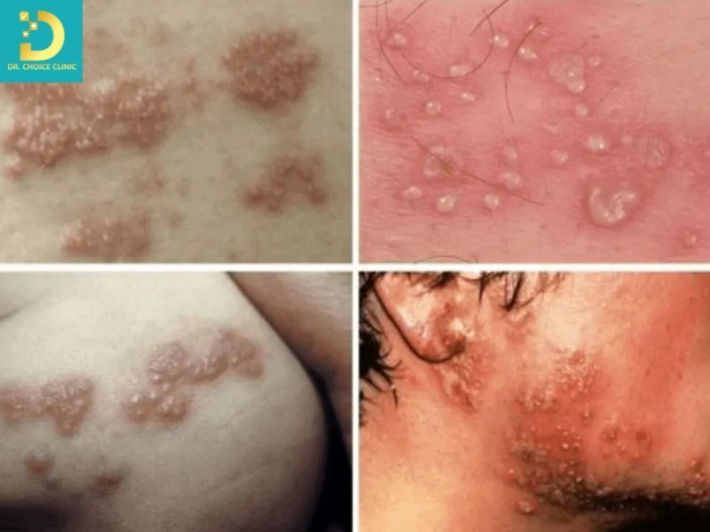 Zona Thần Kinh: Nguyên Nhân, Triệu Chứng, Cách Điều Trị Và Phòng Ngừa 11 Biến chứng zona thần kinh