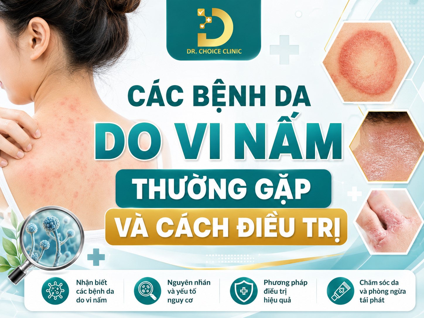 Các Bệnh Da Do Vi Nấm Thường Gặp Và Cách Điều Trị 11 Các bệnh về da do vi nấm thường gặp