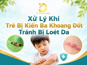 Xử lý khi trẻ em bị kiến ba khoang đốt