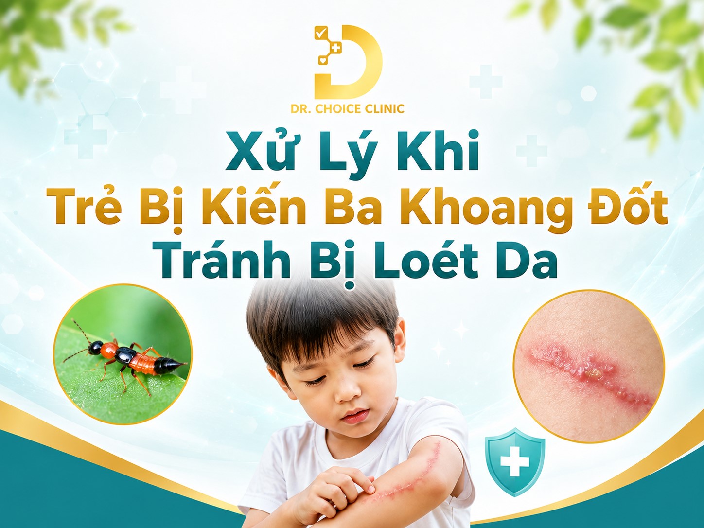 Xử Lý Khi Trẻ Bị Kiến Ba Khoang Đốt Tránh Bị Loét Da 9 Xử lý khi trẻ em bị kiến ba khoang đốt