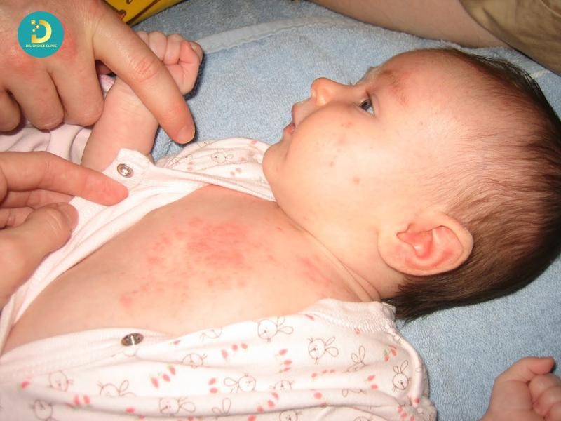 Phân Biệt Chàm Sữa Và Rôm Sảy: Khác Nhau Như Thế Nào? 11 Chăm sóc và điều trị rôm sảy