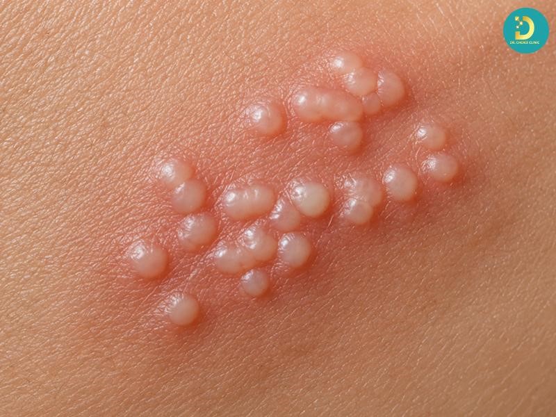 Herpes Là Gì? Nguyên Nhân, Dấu Hiệu & Cách Điều Trị, Phòng Ngừa 14 Dấu hiệu nhận biết bệnh Herpes