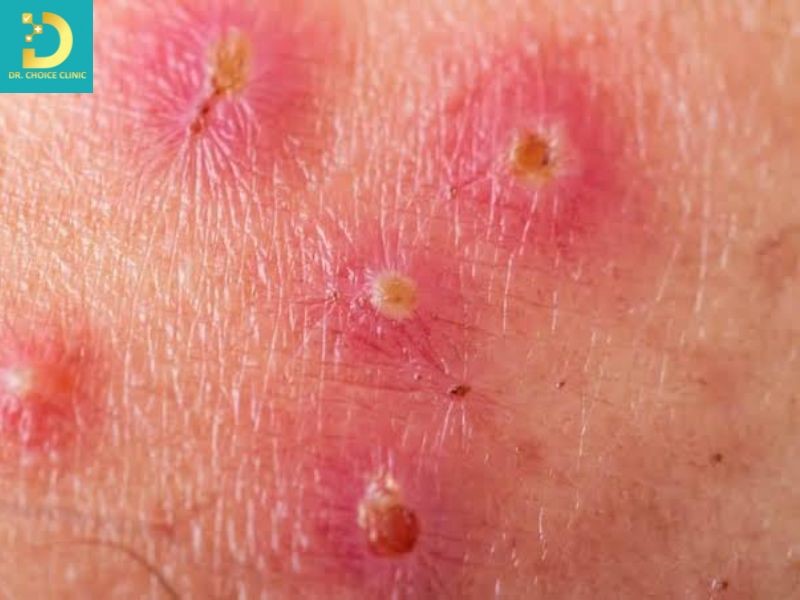 Dấu hiệu gợi ý bội nhiễm vi khuẩn