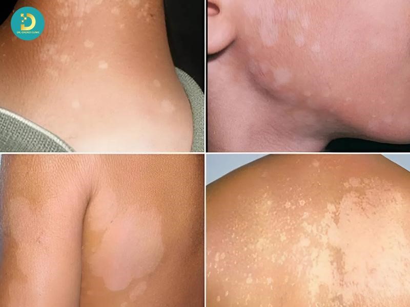 Cách Điều Trị Lang Ben Ở Trẻ Em An Toàn, Hiệu Quả 11 Dấu hiệu lang ben ở trẻ em